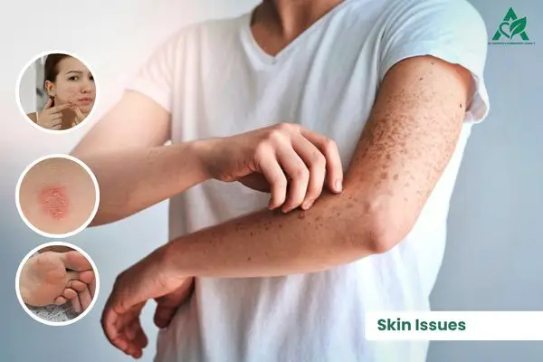 Effective homeopathy treatment for acne eczema psoriasis and corn gokhru